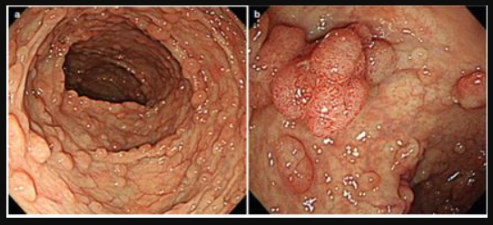 Mối liên hệ giữa hội chứng đa polyp gia đình và ung thư đại trực tràng - Ảnh 1.