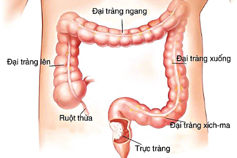 6 cách giúp ngăn ngừa ung thư đại trực tràng - Ảnh 1.