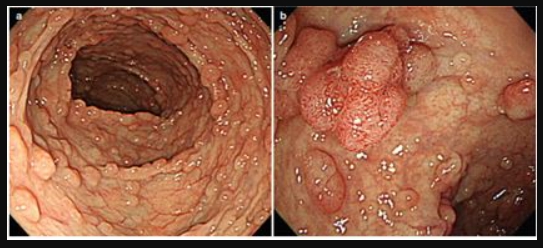 Hội chứng đa polyp gia đình và mối liên quan với ung thư đại trực tràng
