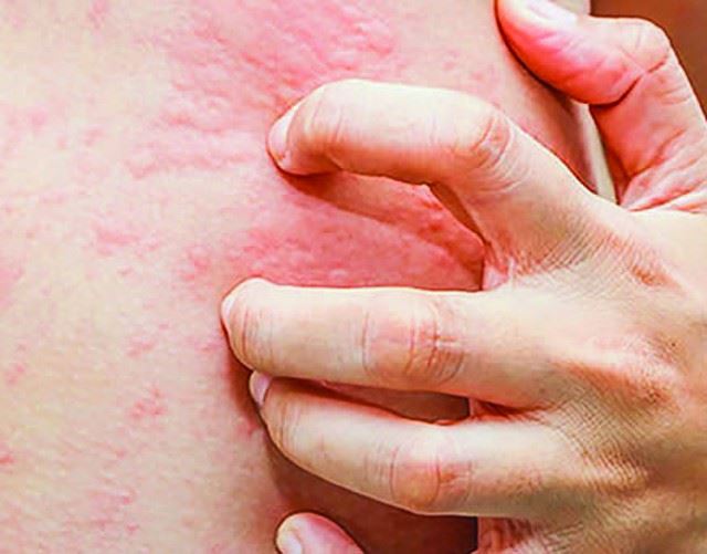 Dị ứng thực phẩm, không chỉ là phiền toái...