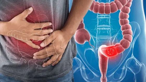 6 Cách giúp ngăn ngừa ung thư đại trực tràng