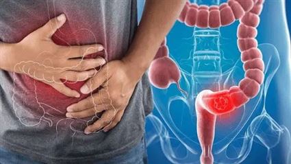 6 Cách giúp ngăn ngừa ung thư đại trực tràng